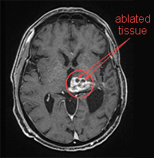 News Flash: Brain Tumor Success - Focused Ultrasound Foundation